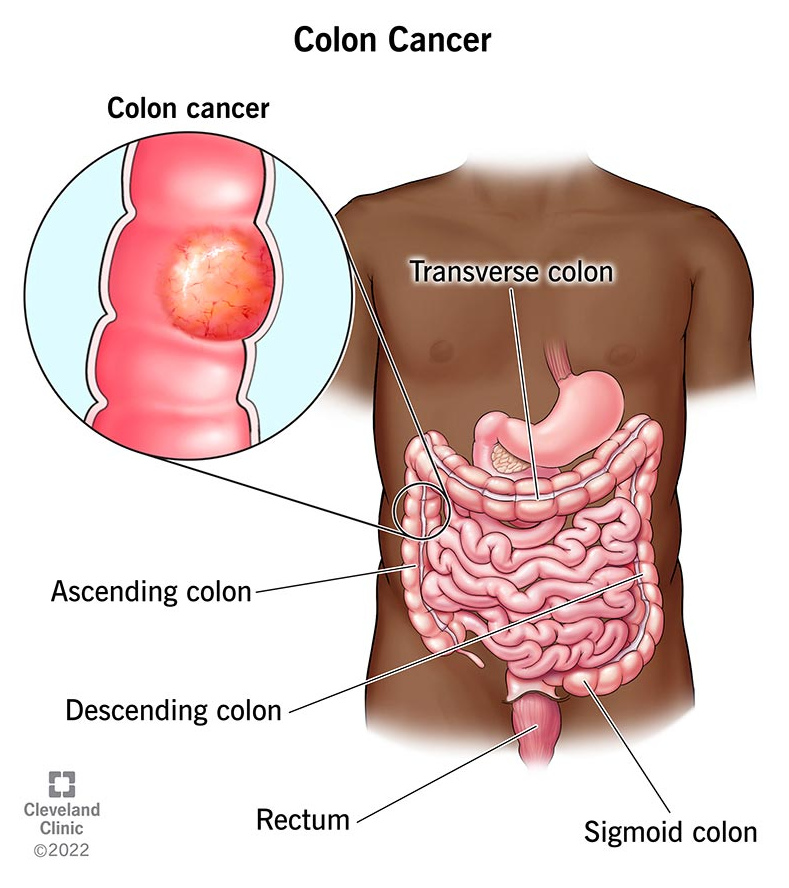 Colon Cancer on the Rise… Turns Out “Blood Sugar Hacks” Might Help Your Gut Too